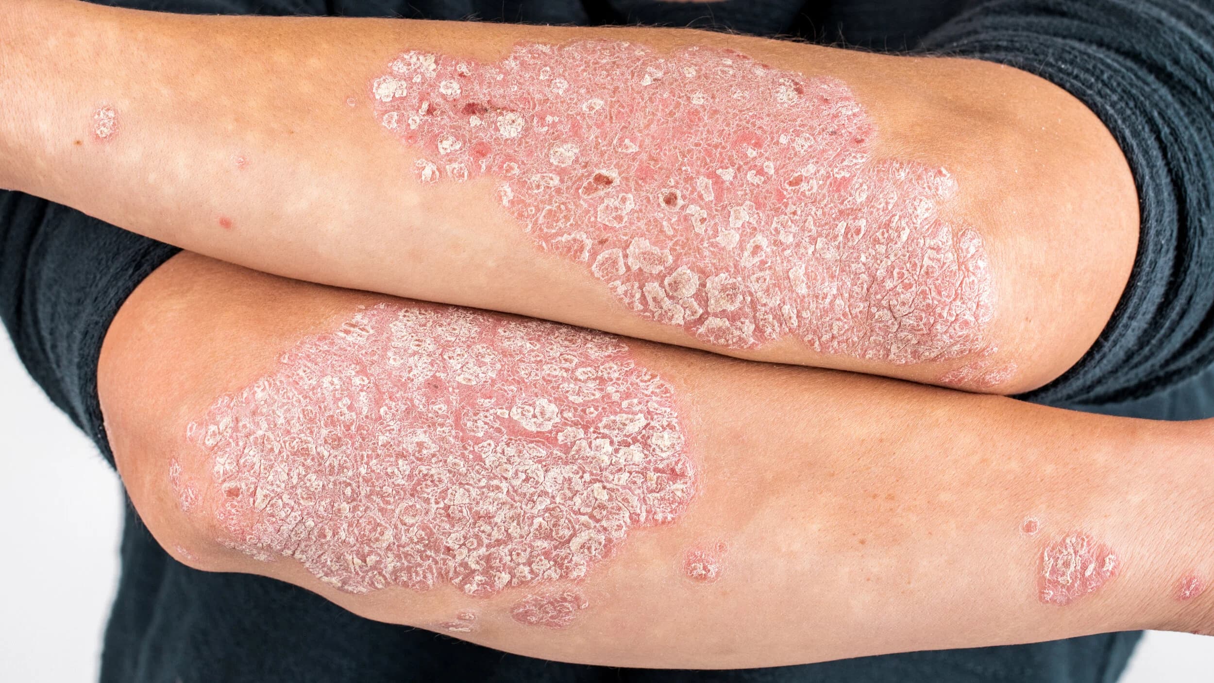 Psoriasis Remission Achieved Through Single-Dose Kalium Bichromicum 1M