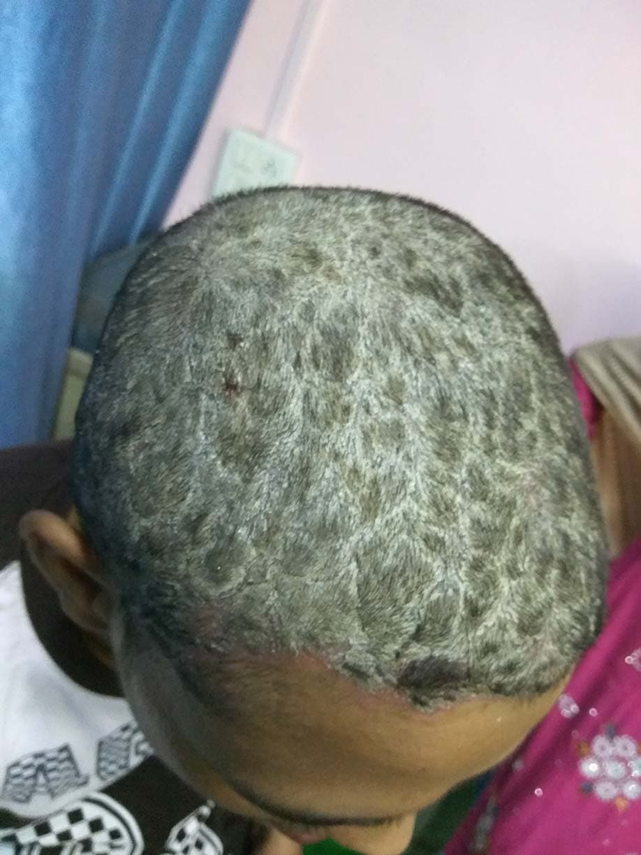 Psoriasis Remission Achieved Through Single-Dose Kalium Bichromicum 1M - Image 1