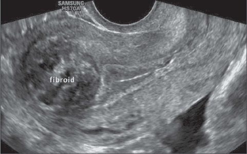 Uterine Fibroids: Understanding the Silent Growths