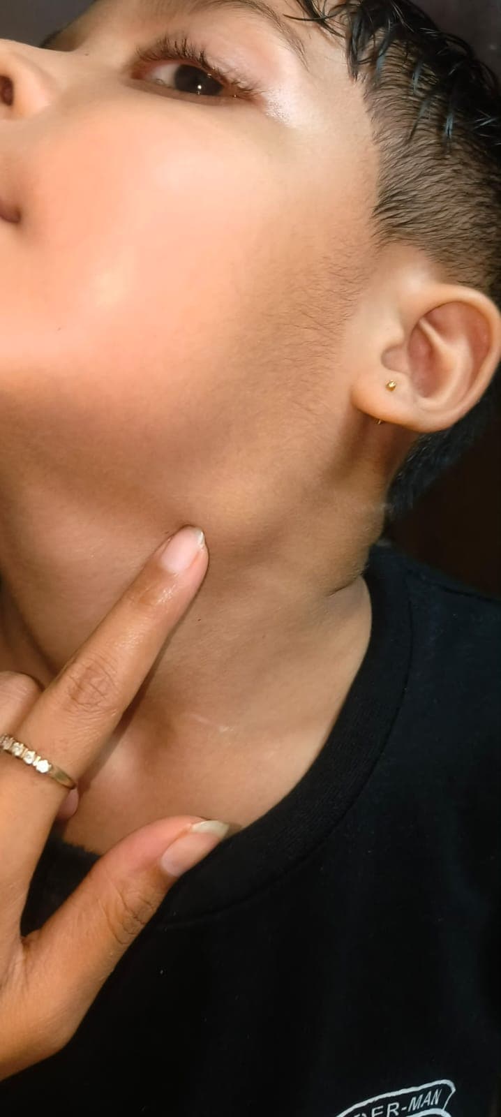 Cervical Lymphadenopathy (Suspected Tuberculosis) with Intense Fever: case resolved by single dose of Lac canainum - 200. - Image 1